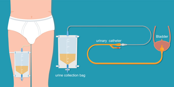 Urinary catheter in the male body with urinary leg bag.