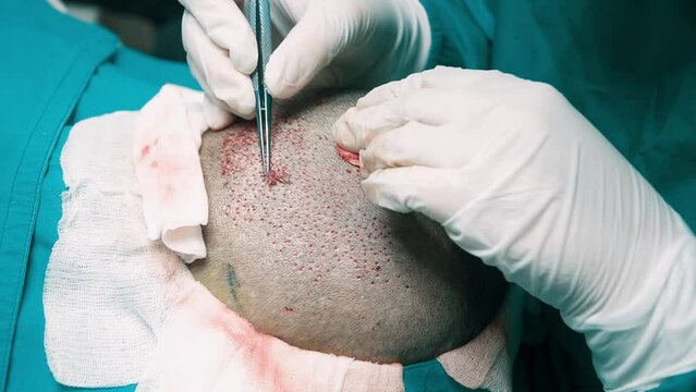 A specialized doctor is currently performing a procedure using forceps to extract hair from the back of the head in preparation for hair transplantation in the bald area of the patient, in the operati