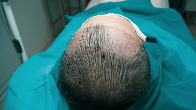 A male patient with baldness issues received a hair transplant surgery performed by a doctor. The procedure involved follicle transplantation and took place in the operating room of a clinic