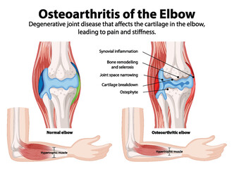 Comparison of normal and osteoarthritic elbow joints