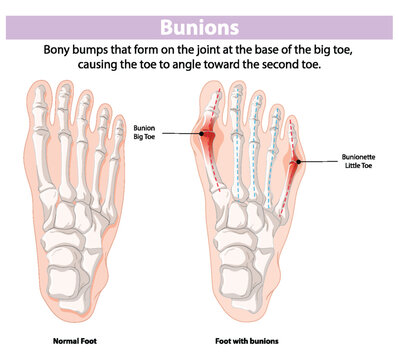 Illustration of normal foot and foot with bunions