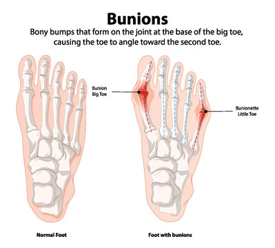 Comparison of normal foot and foot with bunions