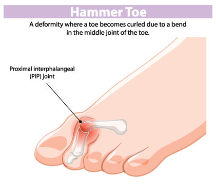 Depiction of hammer toe deformity and PIP joint
