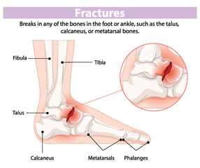 Fototapeta premium Illustration of foot and ankle bone fractures