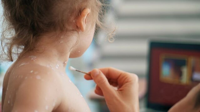 Mother treating her little daughter with varicella or chickenpox at home