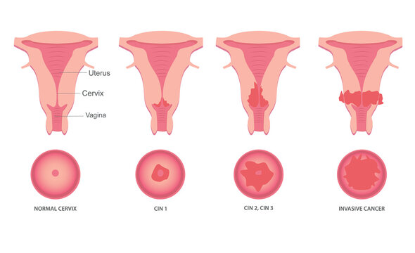 Set of Cervical invasive cancer intraepithelial neoplasia Dysplasia 1 2,3. Female reproductive system Carcinoma view. medical flat style
Biology, anatomy, medicine and healthcare scientific concept. 