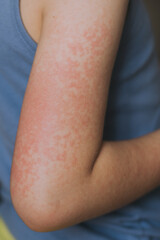 Children's allergies. a boy of European appearance with the first signs of the virus, red spots on...