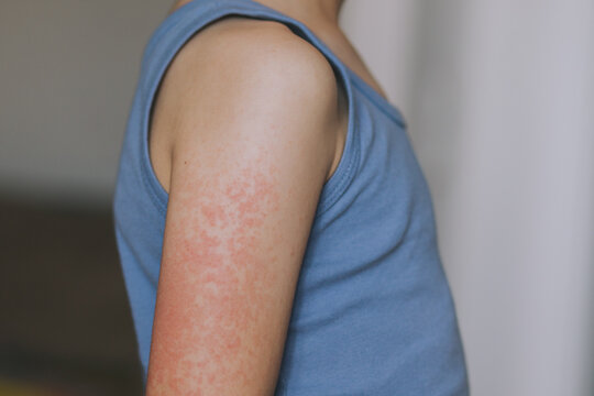 Children's allergies. a boy of European appearance with the first signs of the virus, red spots on his body. Allergy in the hands of a child