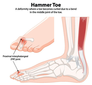 Diagram showing hammer toe deformity and anatomy