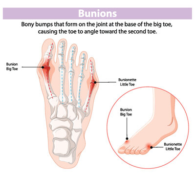 Illustration of bunions on big and little toes