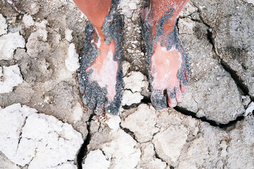 Tourist's foot on Salda Lake shore in Turkiye are covered with healing mud containing magnesium and...