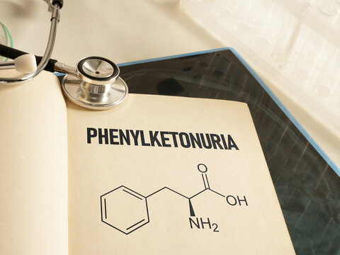 Phenylketonuria is shown using the text on medical photo