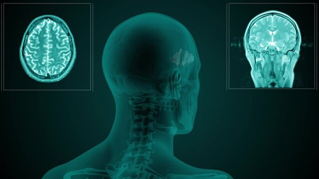 Magnetic resonance scan of the head of a man with visible paranasal Frontal sinus. Anatomically correct 3d animation on dark background