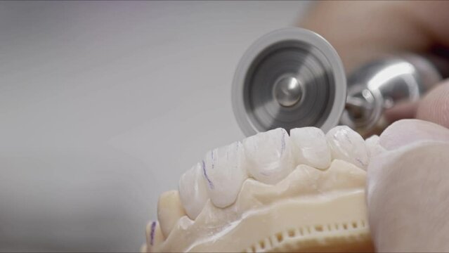Reducing and Rounding of Bordered Implant Zirconium Prosthesis Teeth with Milling Footage.