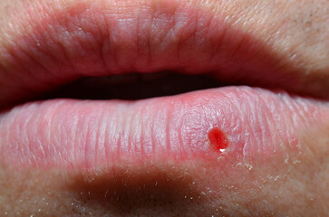 Herpes on the lip of an adult, close-up