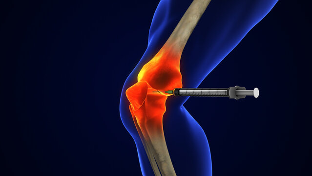 Anatomy Human Knee Joint Treatment, Osteoarthritis Injection