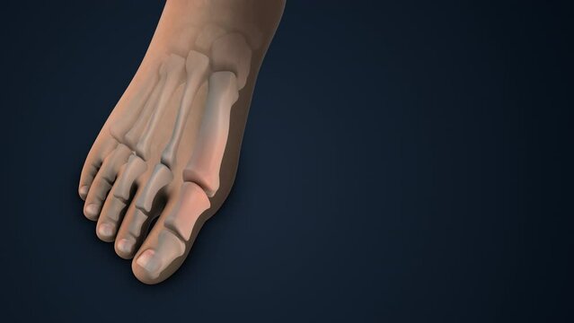 Hallux Valgus Correction Bunion Surgery in foot
