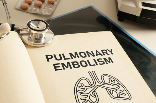 Pulmonary embolism is shown using the text