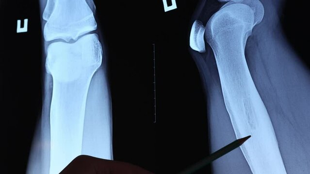 Doctor examining osteoid osteoma, benign bone tumor. X-ray and MRI, MRT, CT with marked sclerosis around the nidus. Medical treatmant concept. Diagnosis of the disease humans bones.