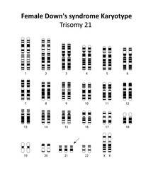 Female Down's syndrome (trisomy 21) human karyotype