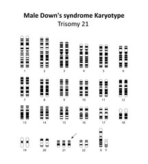 Male Down's syndrome (trisomy 21) human karyotype	