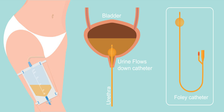 Urinary catheter is a flexible tube used to empty the bladder.