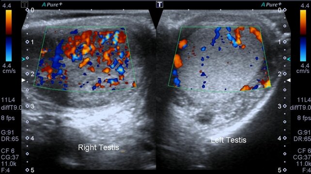 Ultrasonography orchitis testis infection