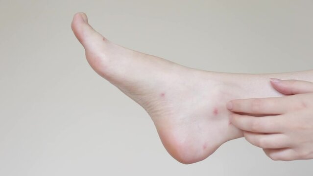 Women's hands scratch their feet and insect bites, mosquitoes and midges close up