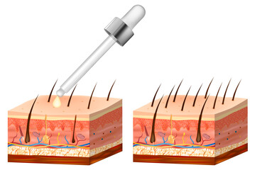 Treatment of alopecia vitamins hair. Number of hair on scalp before and after of treatment loss.