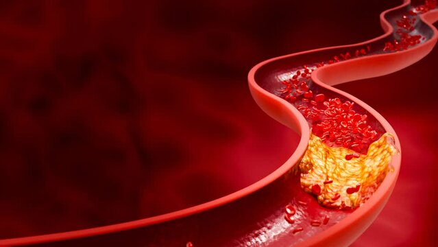 Blocked artery filled with accumulation of fat, cholesterol plaques, blood clots, unhealthy foods, and sugary beverages, illustrating risks of heart disease, stroke, and vascular damage. 3D rendering.