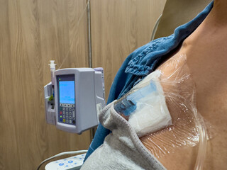 Closeup of woman chest receiving cancer treatment with IV drip