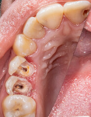 Upper maxillary arch closeup view with decayed teeth, premolars crowns destroyed with visible root...
