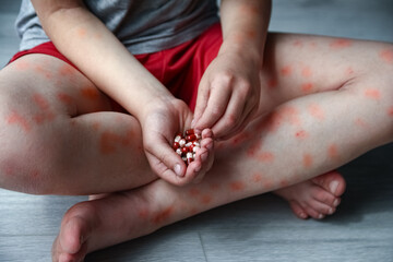 atopic dermatitis on the legs of a child