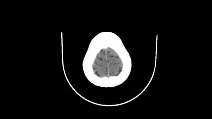 normal head ct scan brain window 
