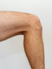 Osgood–Schlatter disease, outer side of male knee in a bent position. Graphic resource of anatomy...