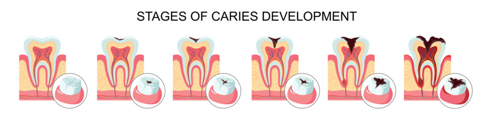 Tooth structure and types of caries. Vector illustration