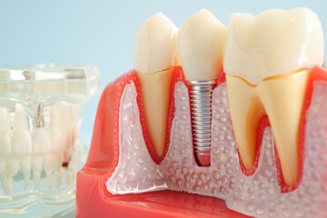 Artificial tooth roots dental implant into jaw, Root canal model for dentist.