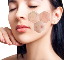 Three zoom hexagons shows skin problems on woman face.