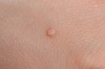 Common wart Verruca vulgaris - flat wart ,close-up. HPV.
