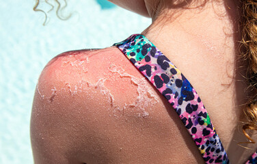 Close up view of child shoulder with severe sunburn. Red skin with dead skin peeling off outdoors...