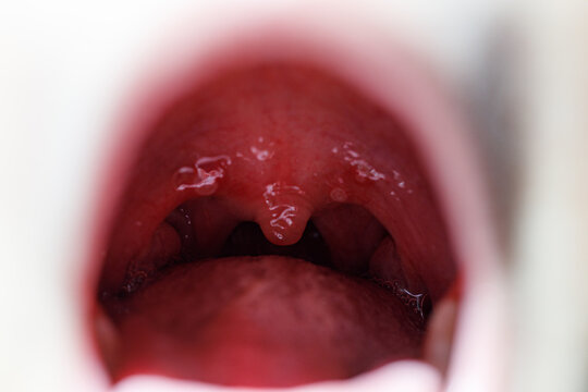 Coxsackie virus in a child. Variety of enterorovirus, herpangina. is a common childhood illness caused by a virus. It is characterized by small,