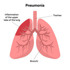 Lungs infection, viral pneumonia medical disease illustration 