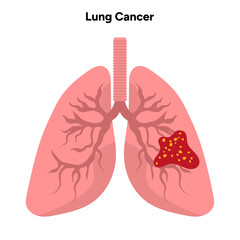 Lungs cancer medical disease illustration 