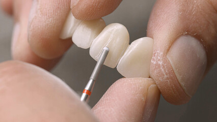 A dental technician is producing e-max and zirconium veneers. Glass-ceramic porcelains used for dental porcelain veneer treatment in dentistry. Laminate veneers and crown veneers.