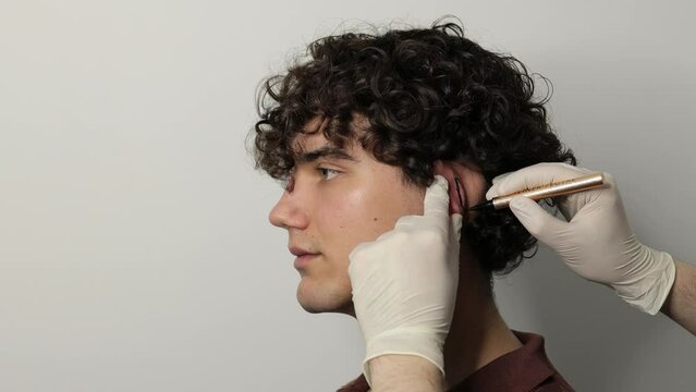 4k video applying markup on ear pinna to correct the shape of ears. Otoplasty markup making on ear. Surgeon drawing markup lines before Otoplasty surgeon on ears.