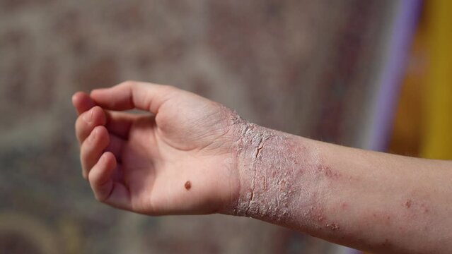 Close-up of a girl's hand diagnosed with atopic dermatitis