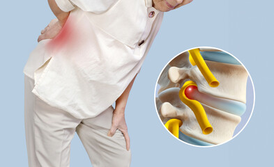 An elderly woman is experiencing back pain due to a herniated disc.