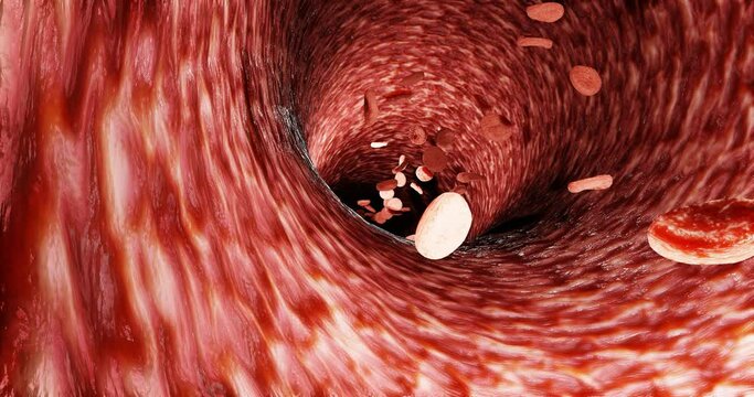 Fat clogs the arteries in the body. LDL. low-density lipoproteins.3d rendering. Chronic non-communicable diseases. Causes of heart disease. Sickness. Dangerous to health.