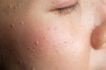 Seborrheic keratosis, pore, acne and wrinkles in face woman skin macro. Facial care skin problems...