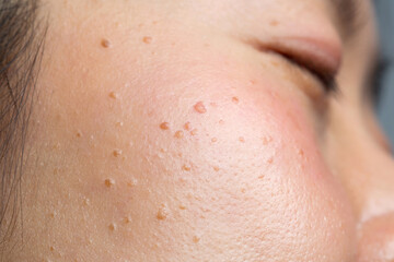Closeup seborrheic keratosis, pore, acne and wrinkles in face woman skin macro. Facial care skin...